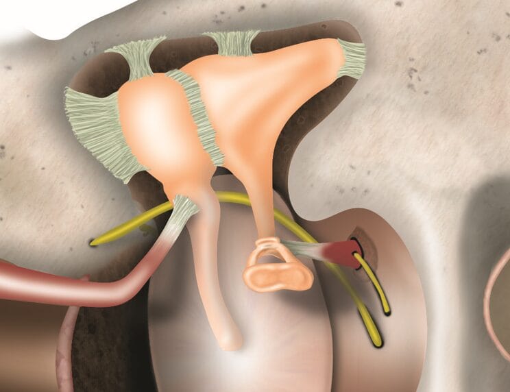 Otosclérose Otospongiose étrier marteau enclume tympan et appareil auditif